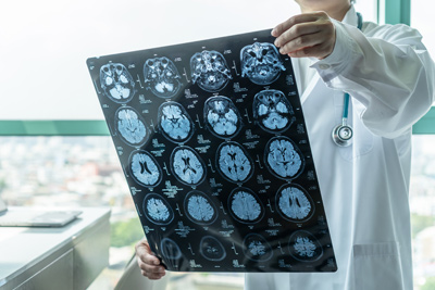 CT scan alzheimers disease