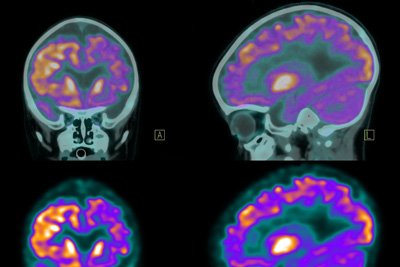 PET brain imaging scan