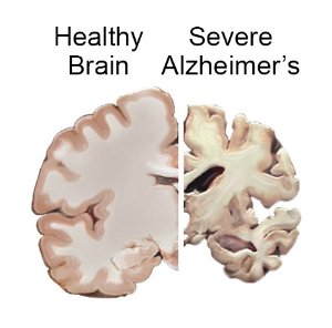 healthy brain versus alzheimers brain